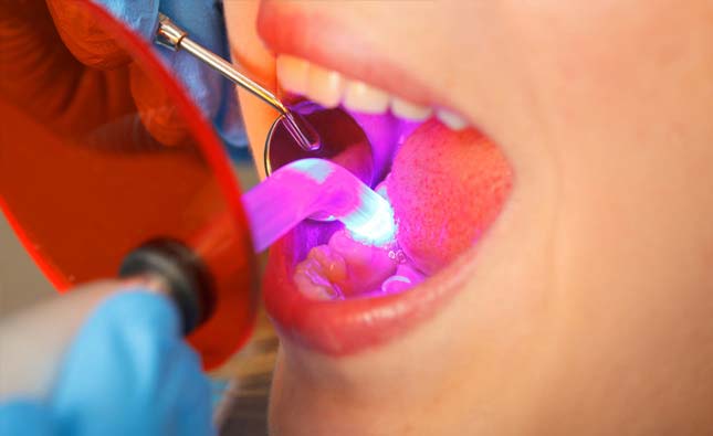 Stock image of a patient mouth who is undergoing dental bonding