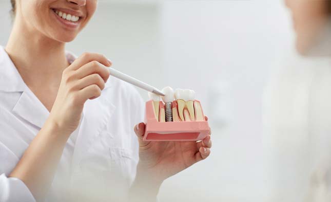 Stock image of a dentist showing dental implants model