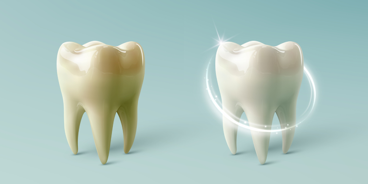 Featured image for How Often Should You Have Your Teeth Whitened?