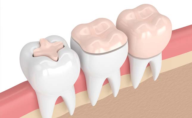 Stock image showing inlays and outlays for teeth