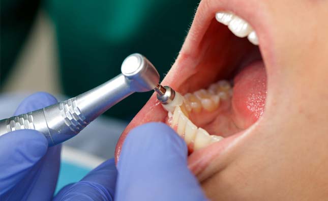 Stock image of a patient undergoing teeth cleaning with his mouth wide open