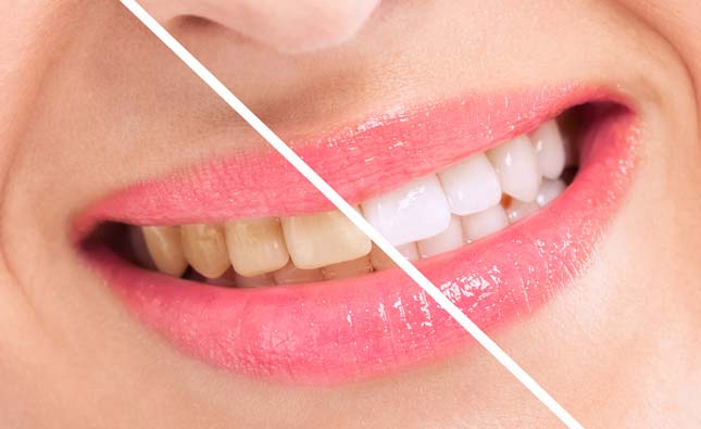 Stock image of teeth of a model before and after teeth whitening