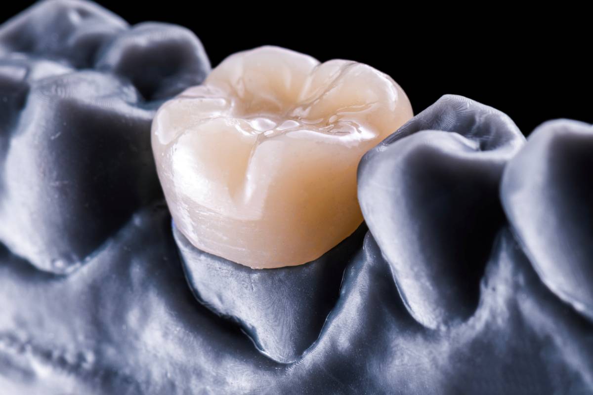 featured image for bite issues affecting dental crowns